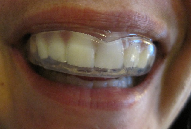person wearing oral appliance